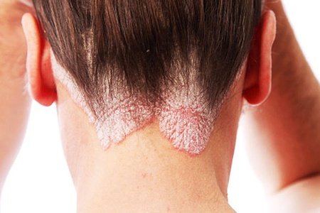 Sedef (Psoriasis)