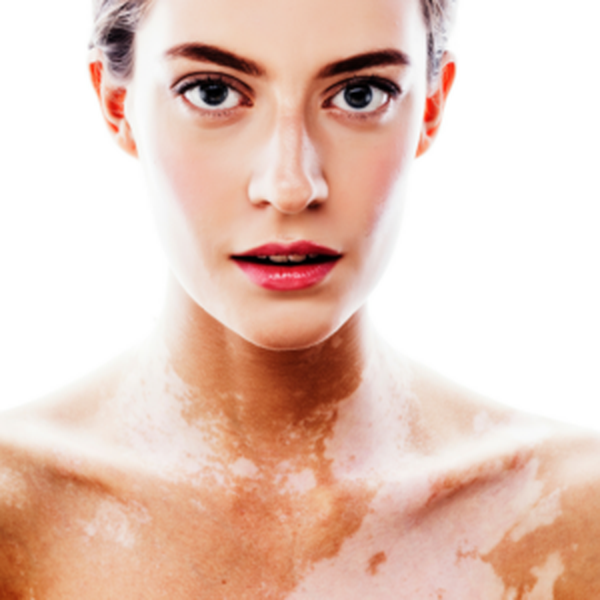 Vitiligo