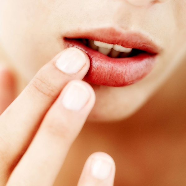 Uçuk (Herpes)