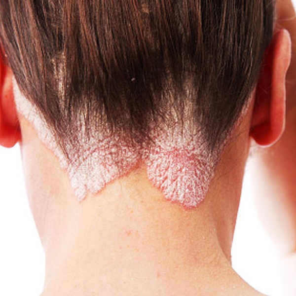 Sedef (Psoriasis)
