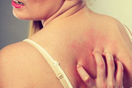 Eczema