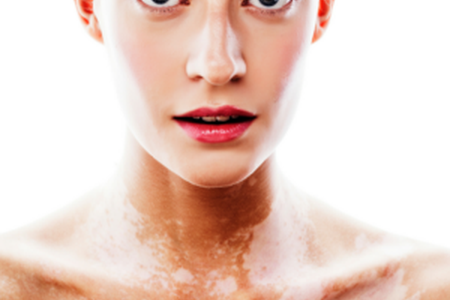 Vitiligo