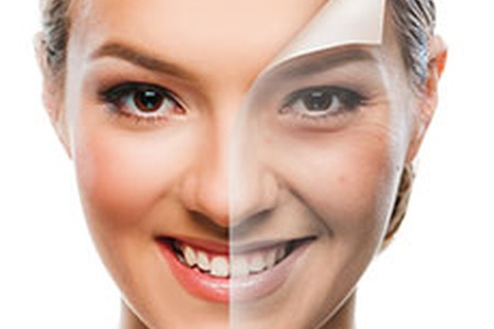 Kimyasal Peeling