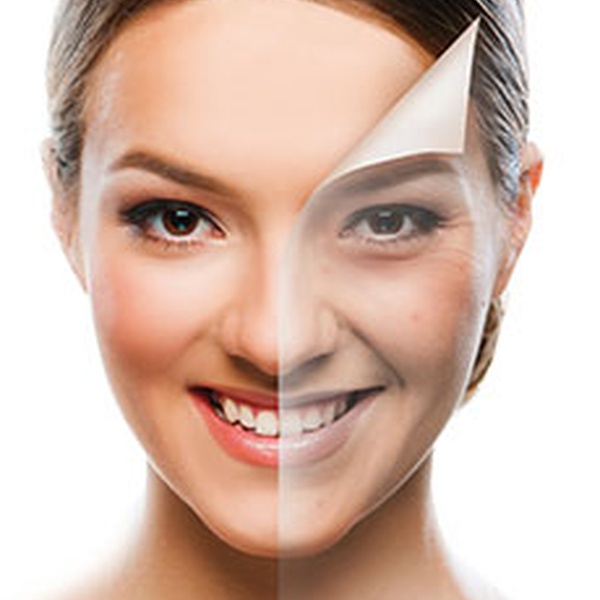 Kimyasal Peeling